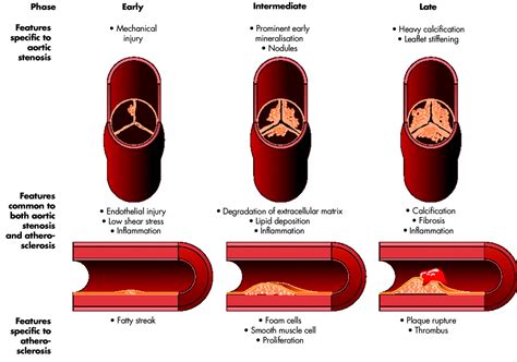 Atherosclerosis and Aortic Stenosis