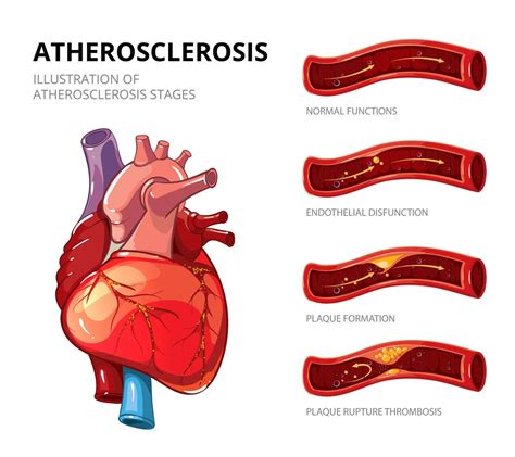 Atherosclerosis Symptoms