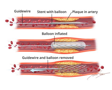 Atherosclerosis Treatment
