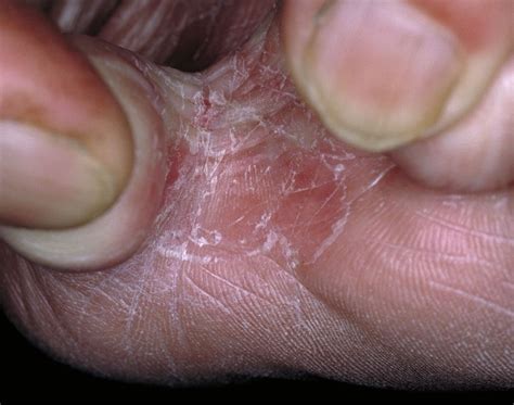 Athlete's foot and other foot conditions