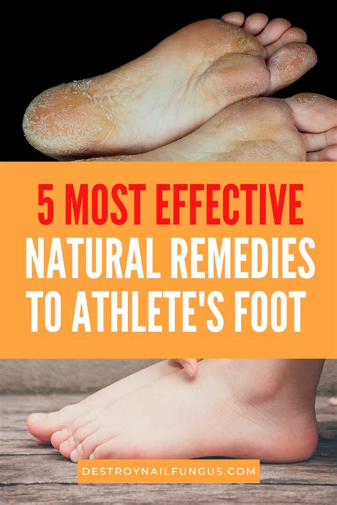 Athlete's foot future