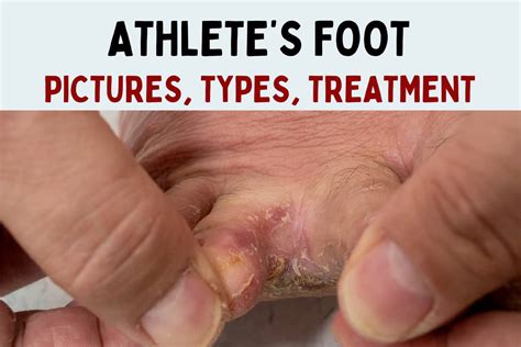 Athlete's foot lifestyle