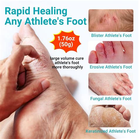 Athlete's foot treatment options