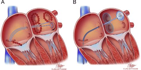 Atrial Fibrillation Catheter Ablation Mechanism