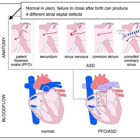 Atrial Septal Defect Research