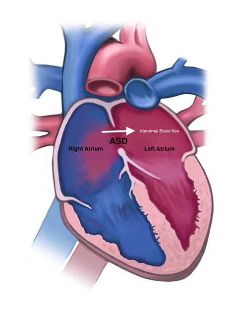 Atrial Septal Defect Treatment
