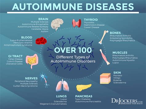 Autoimmune Disorders