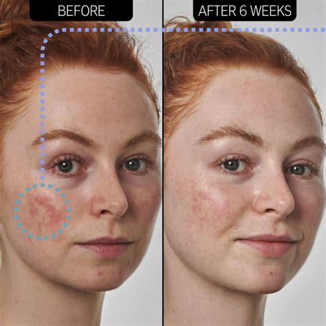 azelaic acid for hyperpigmentation