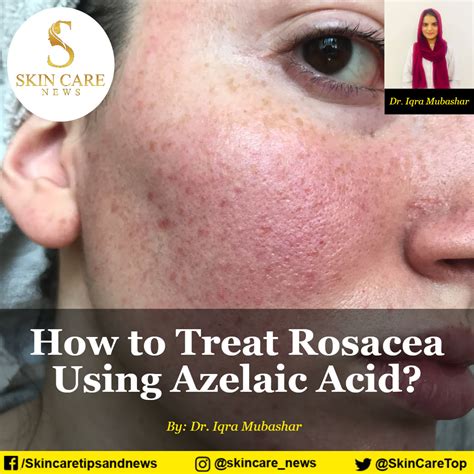 azelaic acid for rosacea treatment