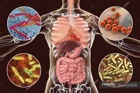 bacterial infections