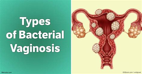 Bacterial Vaginosis