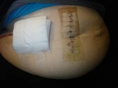 Belly Button Hernia Repair Surgery Benefits