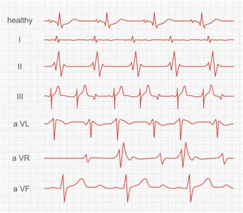 benefits of electrocardiogram