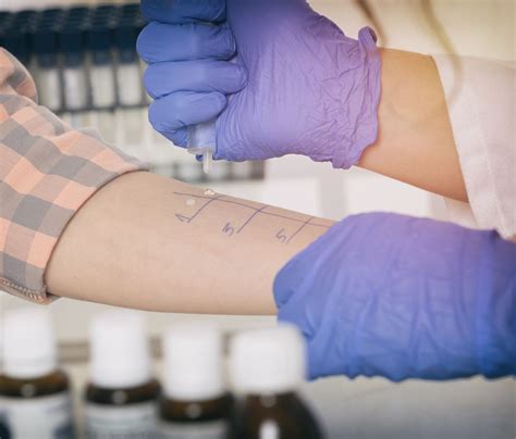 Benefits of allergy skin tests