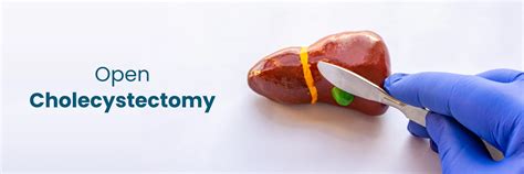 Benefits of Cholecystectomy Surgery