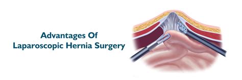 Benefits of Surgical Hernia Repair