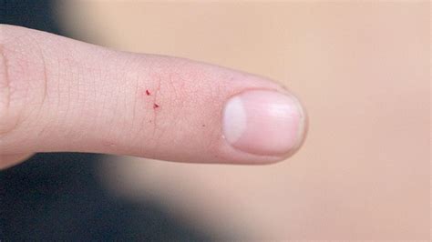 black widow bite first aid