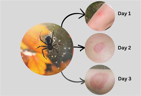Black Widow Bite Long-Term Effects