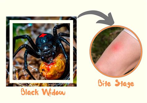 Black Widow Bite Symptoms