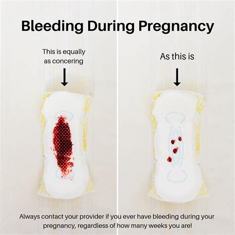 Bleeding During Pregnancy Image