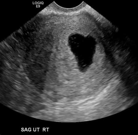 Blighted Ovum Causes