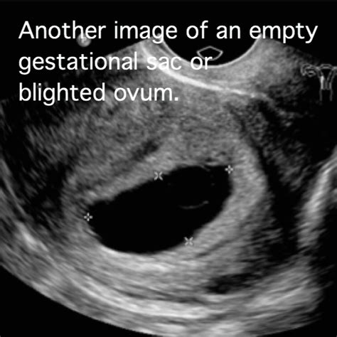 Blighted Ovum Prevention