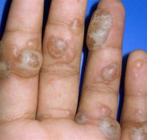 Blisters on hands