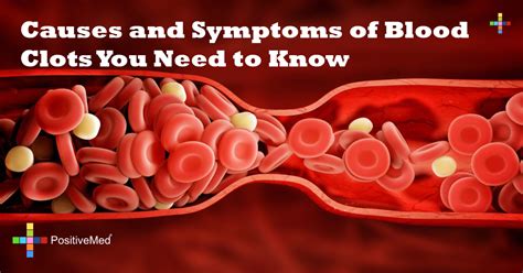 blood clot diagnosis