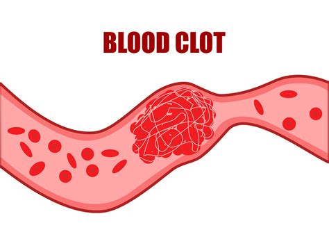 blood clots risk factors