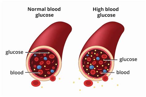 blood sugar and diabetes