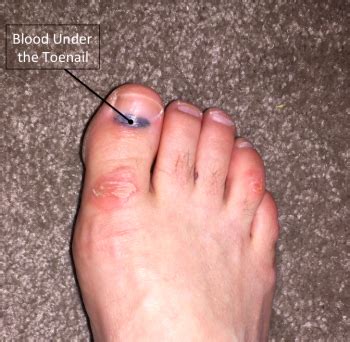 blood under toenail causes