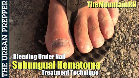 blood under toenail home remedies
