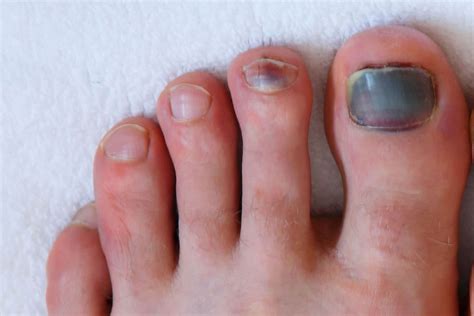 blood under toenail prevention