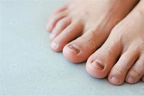 blood under toenail symptoms