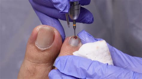 blood under toenail treatment options