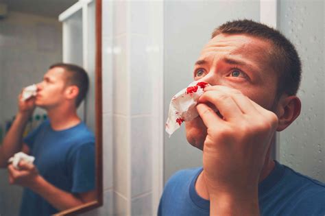bloody nose causes