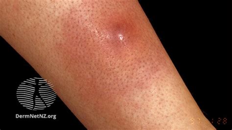 Boil Symptoms