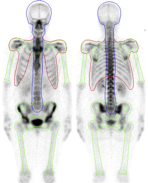 Bone Scan Image