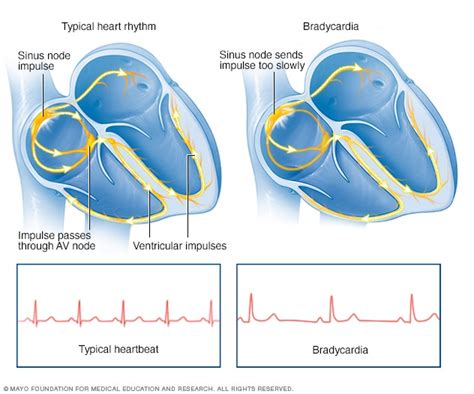 Bradycardia Complications