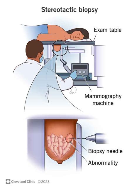 Breast Cancer Biopsy Conclusion