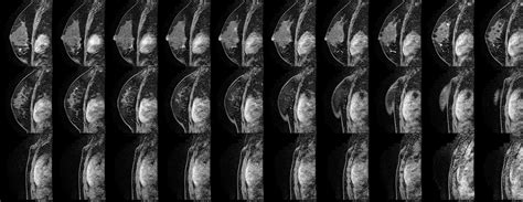 Breast Cancer Biopsy Results