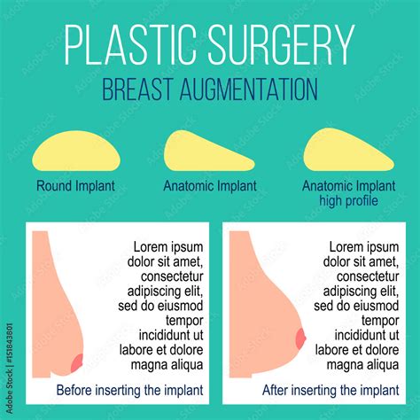 breast enlargement procedures