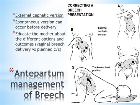 Breech birth management