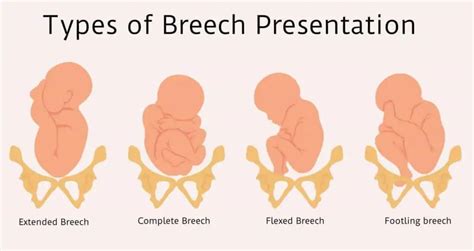 Breech birth types