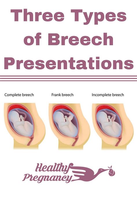 Breech pregnancy support