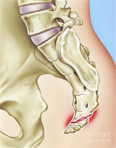 Broken Coccyx Symptoms