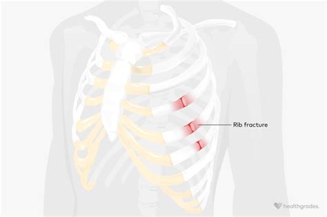 Broken Rib Fracture Symptoms