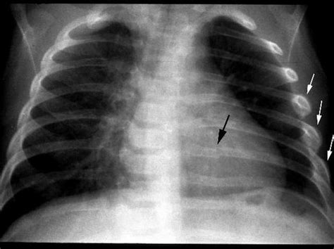 bruised ribs