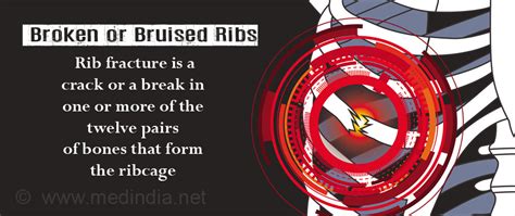 bruised ribs under breast
