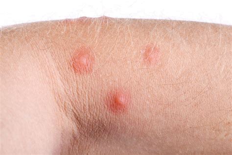 bug bites
